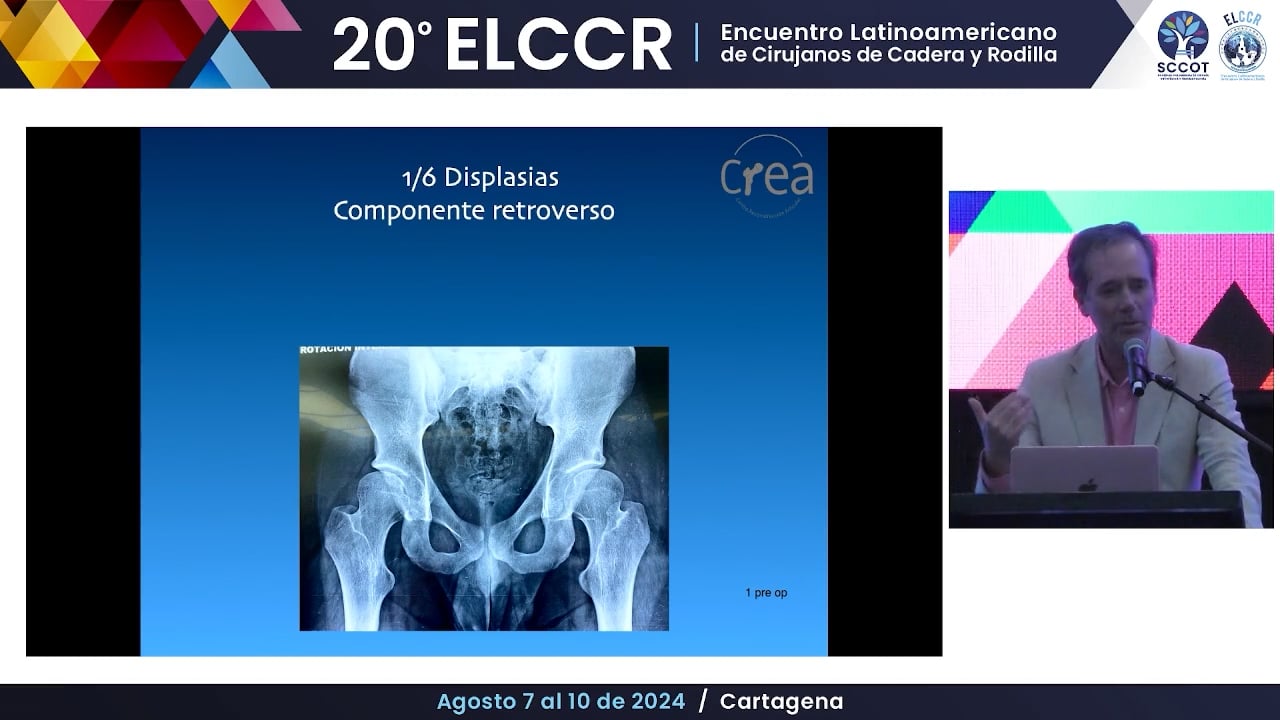 Retroversión acetabular  Cuándo osteotomía periacetabular