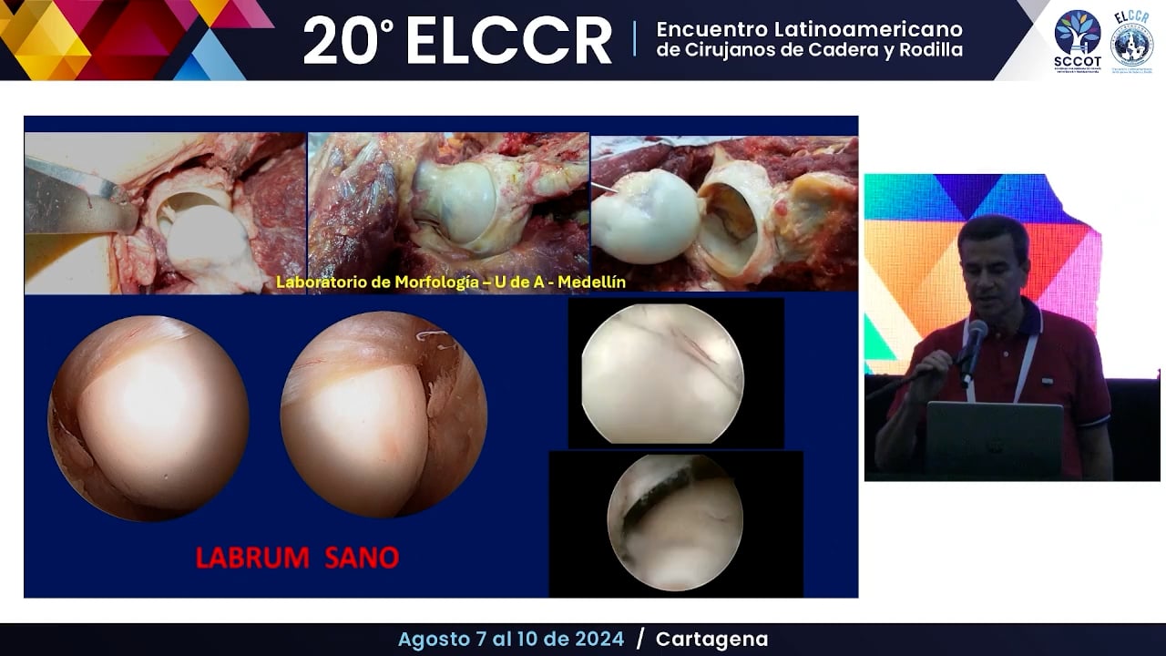 Lesiones irreparables del labrum ¿Qué hacer?