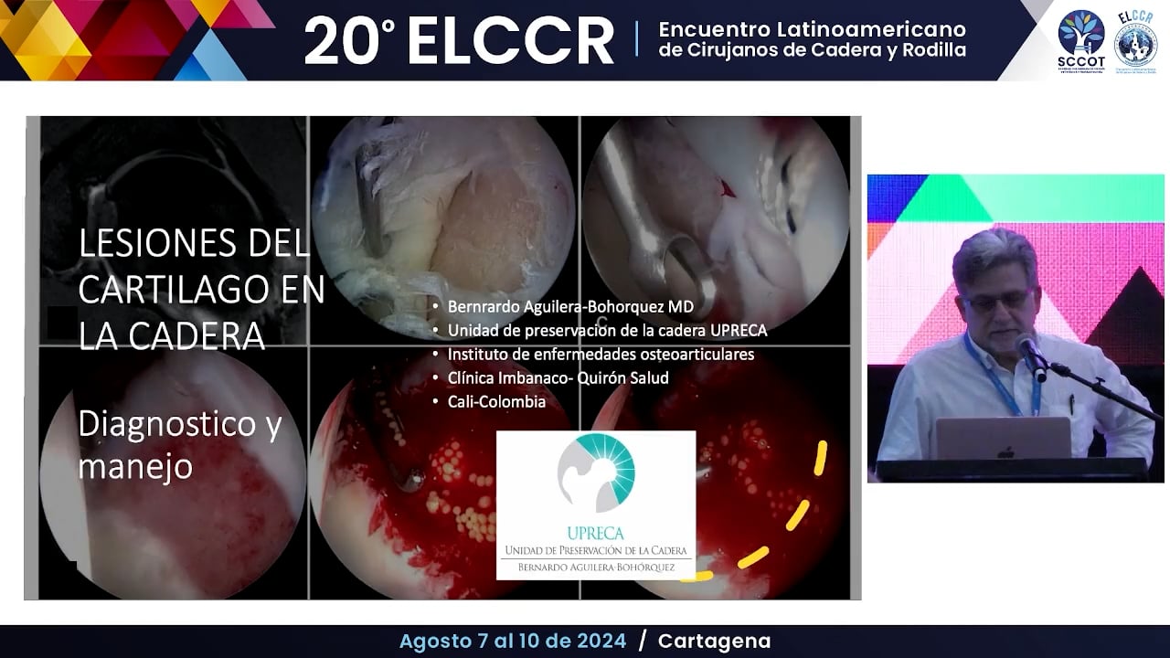 Manejo de lesiones condrales en la cadera