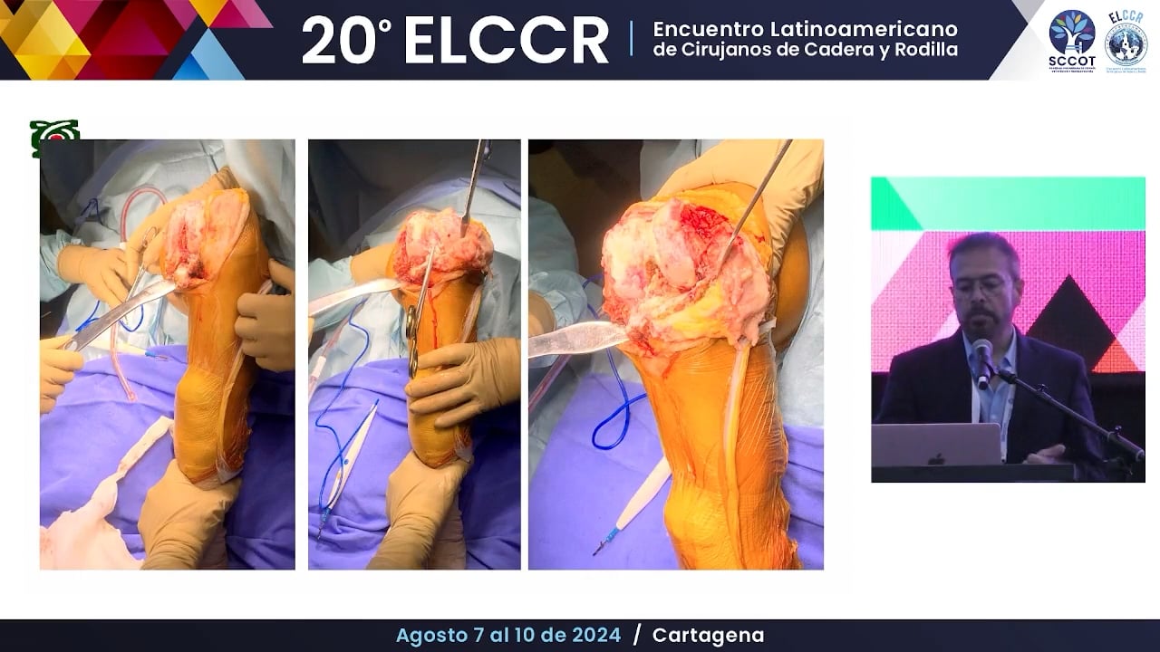 Artroplastia primaria compleja de rodilla con robot ¿Cómo lo hago?