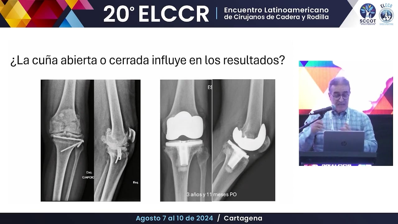RTR posterior a osteotomías