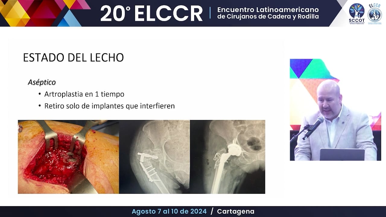 RTC posfractura pertrocantérica fallida