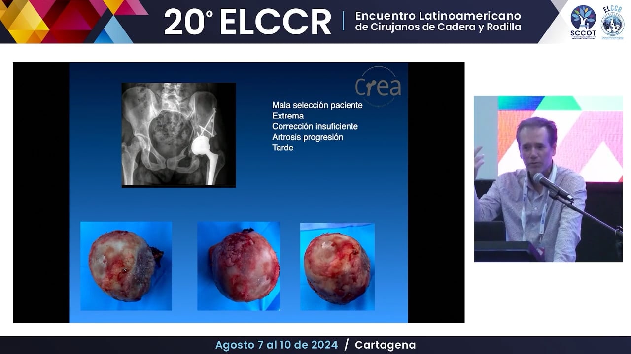 RTC post osteotomía pélvica