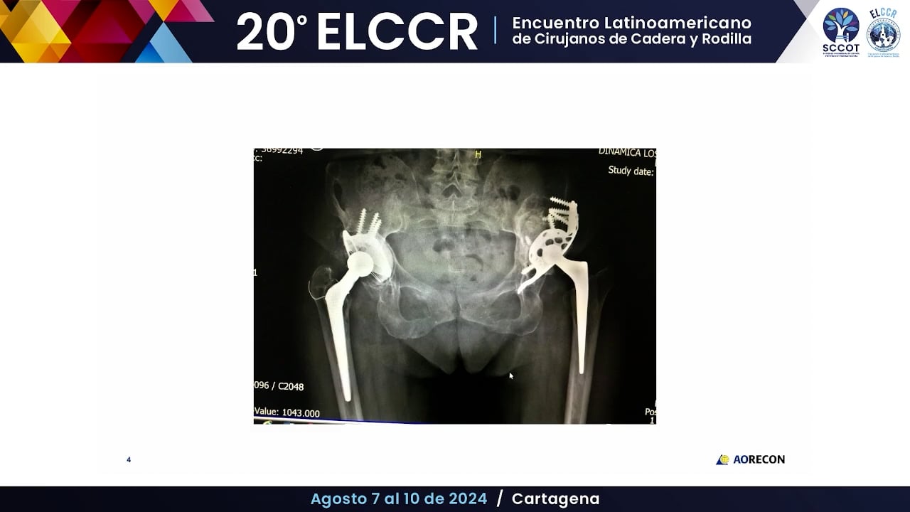 Defectos acetabulares Tipo III Aloinjerto vs columnas de metal poroso