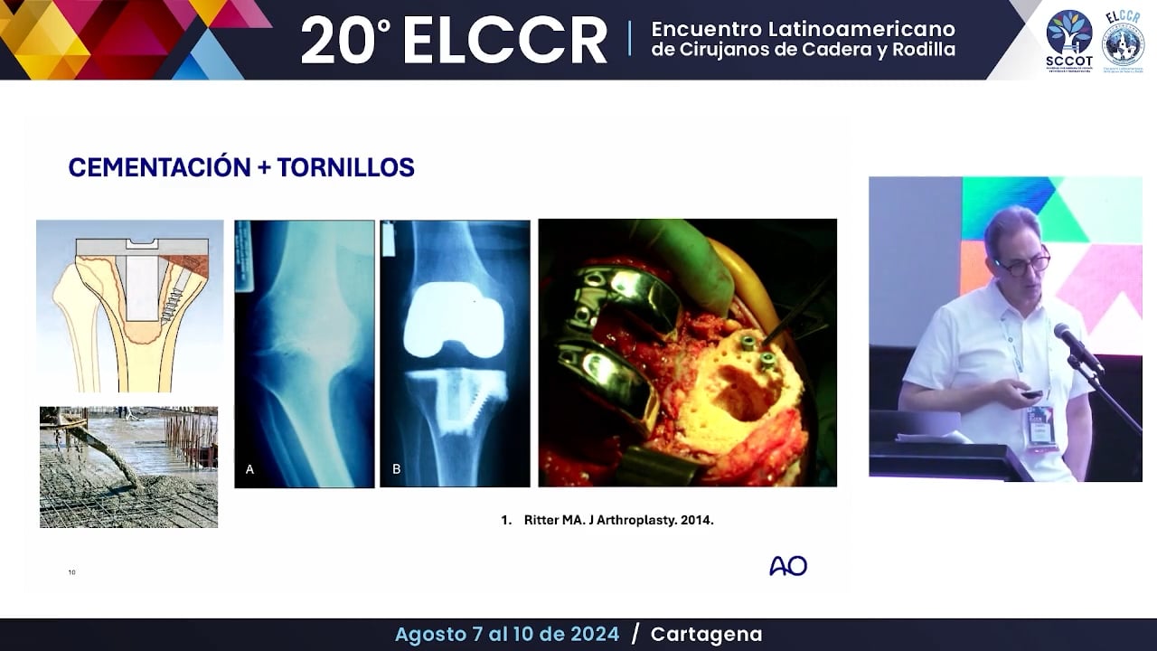 Defectos epifisiarios en rodilla Alternativas y algoritmo de manejo