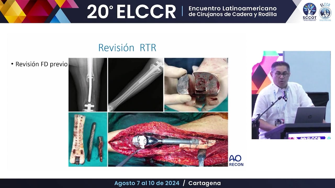 Defectos masivos y prótesis de sustitución tumoral en rodilla