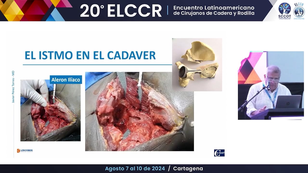 Manejo de la discontinuidad pélvica con fijación al istmo de iliaco
