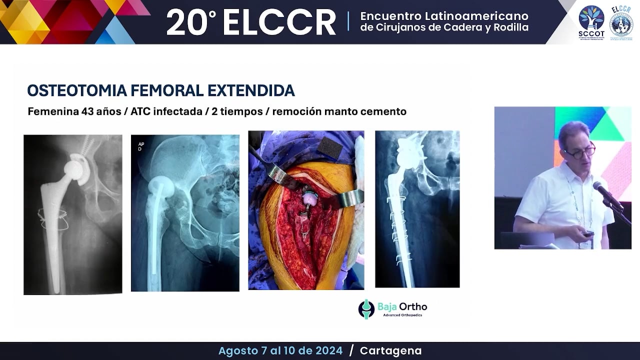 Osteotomías trocantéricas ¿Cómo y cuándo?