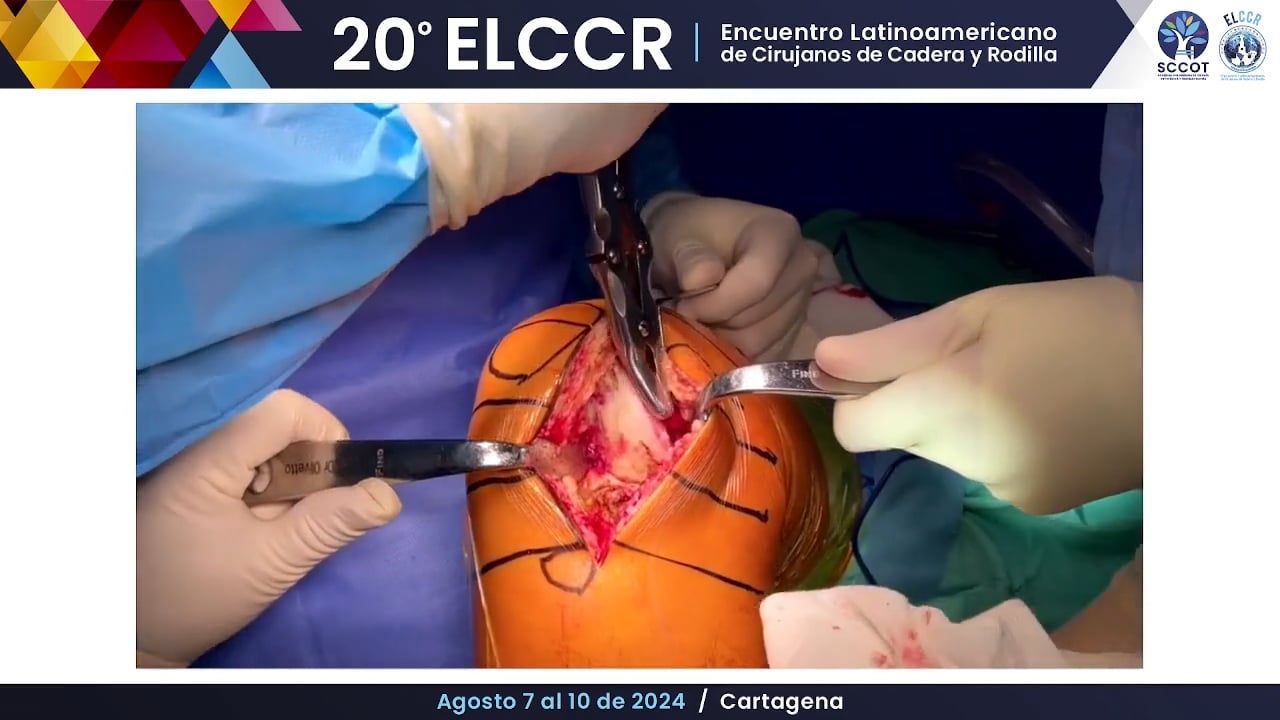 Consejos técnicos para un reemplazo unicompartimental exitoso. Video técnica quirúrgica