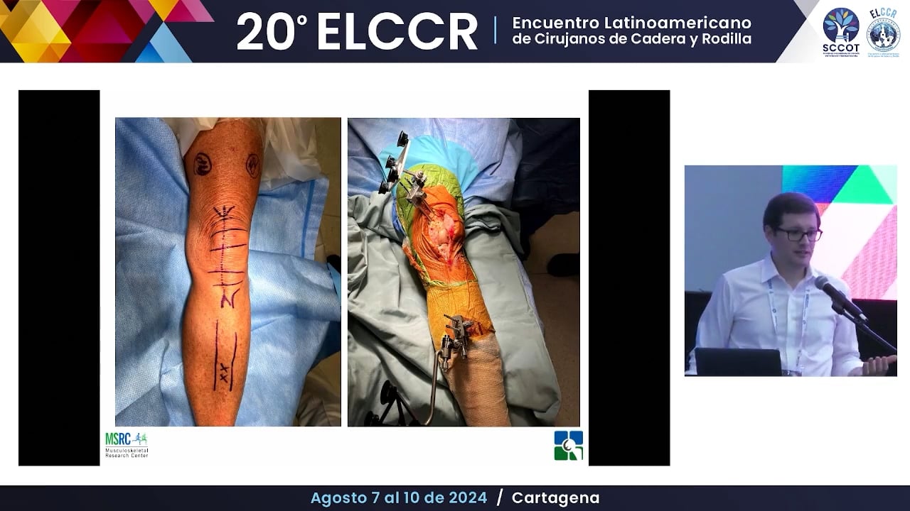 Reemplazo unicompartimental en paciente joven cuándo es la mejor opción