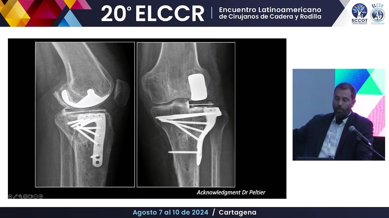 Reemplazo unicompartimental lateral en artrosis post-traumática