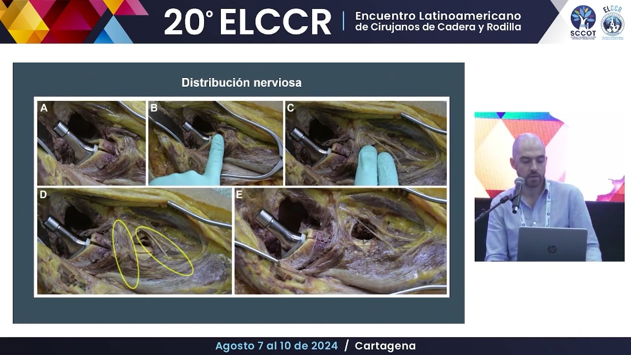 Osteotomías para retiro de implantes en revisiones de reemplazos articulares