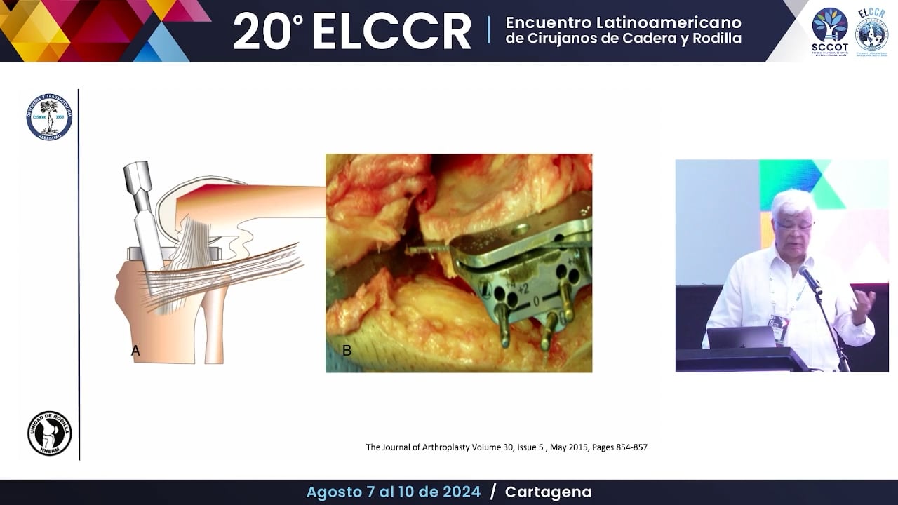 Lesiones del ligamento colateral interno y ahora ¿Qué hago?