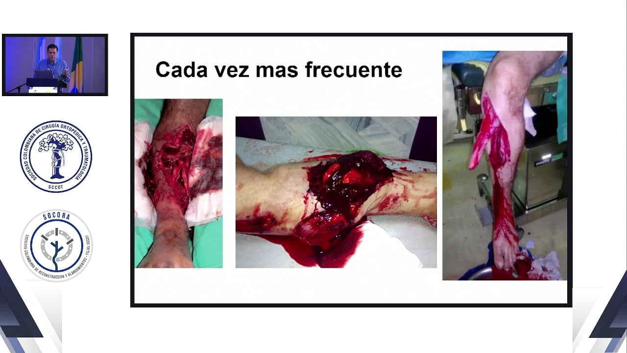 Manejo definitivo de fractura con fijación externa tiene papel