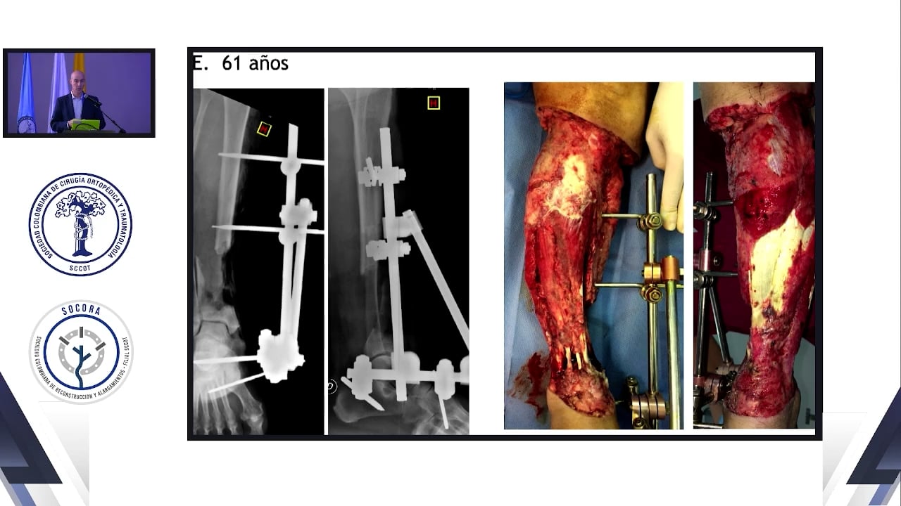 Algoritmo de tratamiento de fracturas expuestas articulares