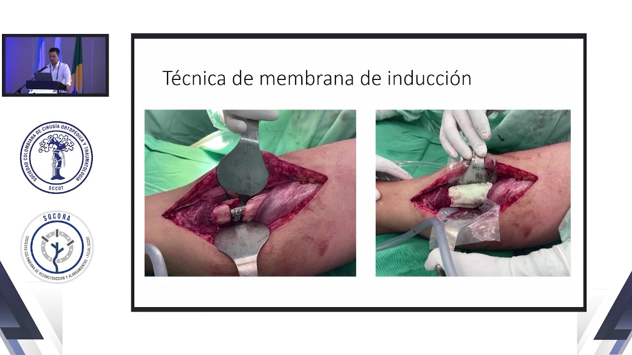 Tácticas de masquelet en pseudoartrosis de cadera