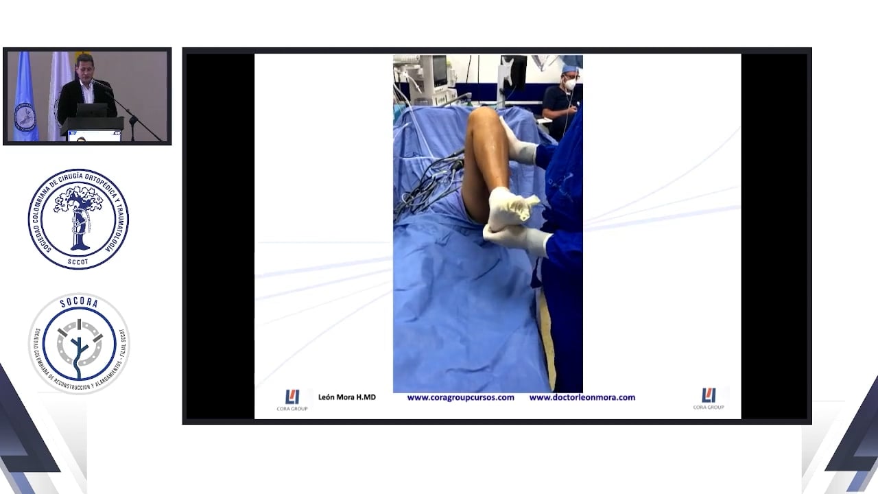 Osteotomías correctoras alrededor de la rodilla con asistencia de artroscopia