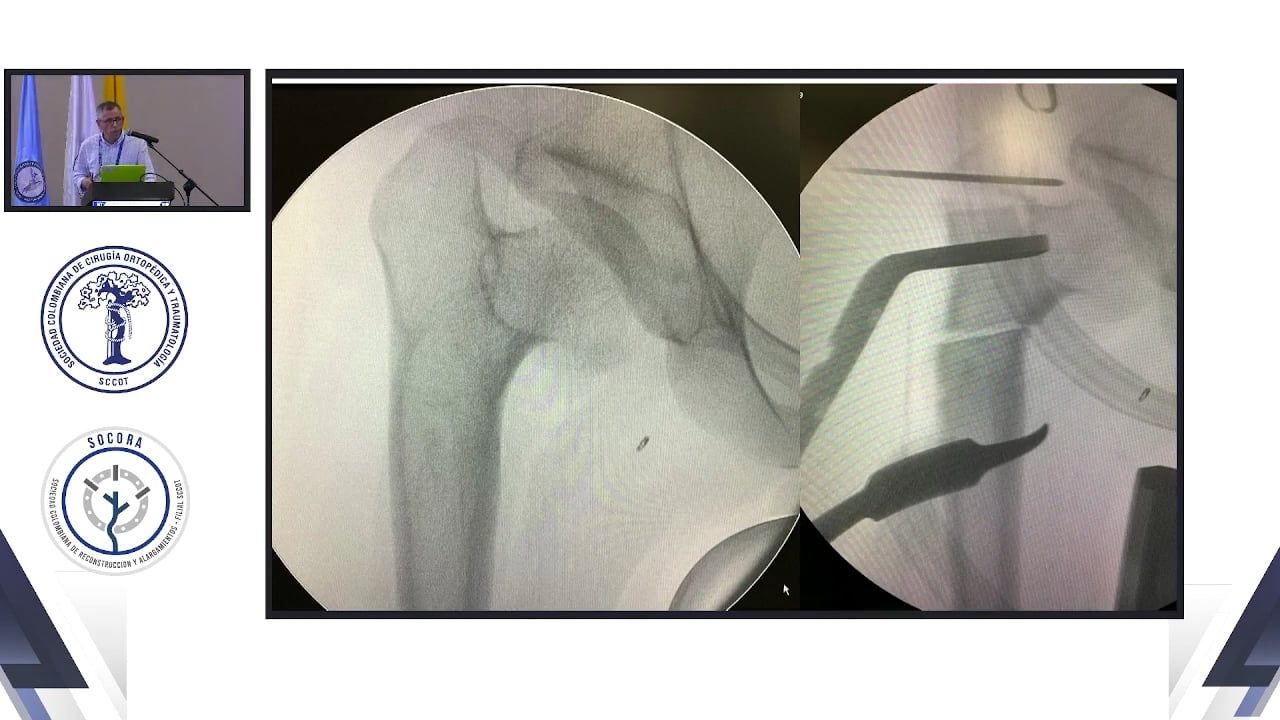 Osteotomías alrededor de la cadera por artrosis, mejor que reemplazo articular