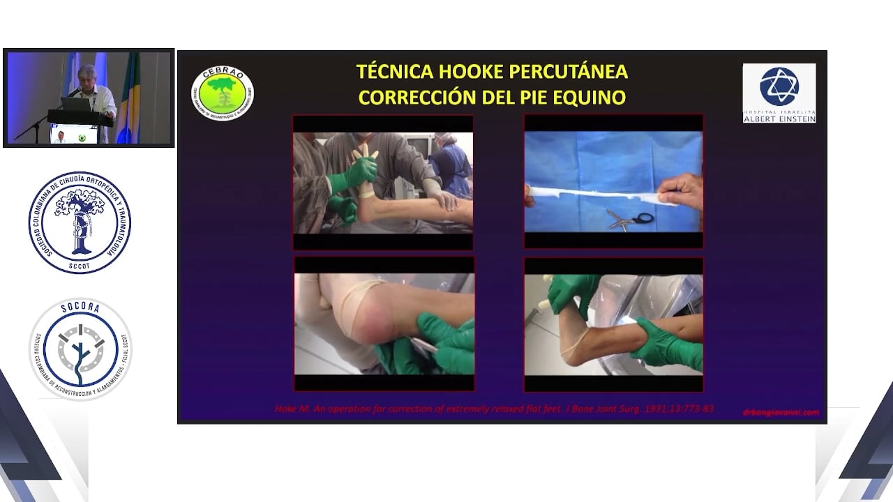 Nueva técnica mis Bongiovanni-Amaya para osteotomías en huesos largos y grandes