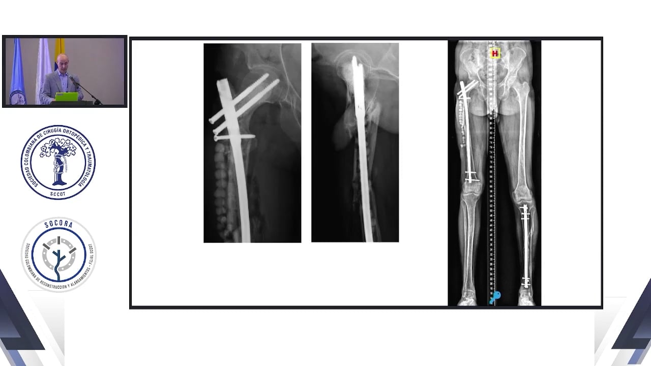 Manejo de infecciones en fracturas inter y subtrocantéricas