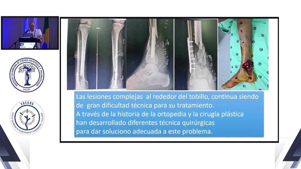Colgajo peroneo reverso en la solución de lesiones de tobillo