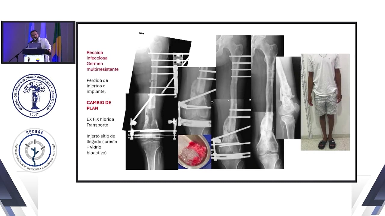 Salvamento luego de infección en fracturas articulares