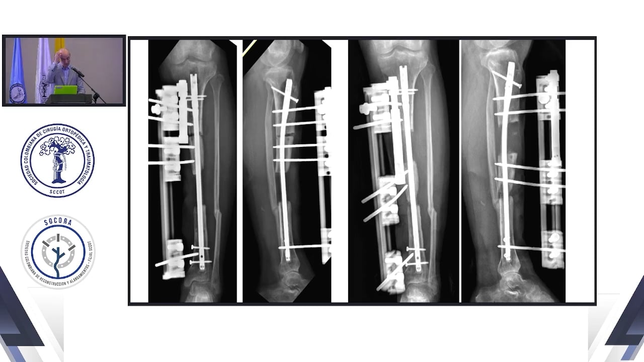Pseudoartrosis infectada de tibia algoritmo de tratamiento