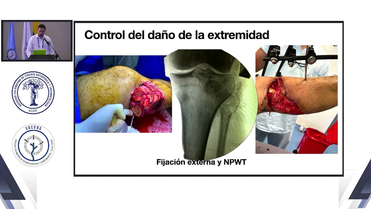 Manejo definitivo de una fractura expuesta (casos complejos) Por qué fix and flap temprano