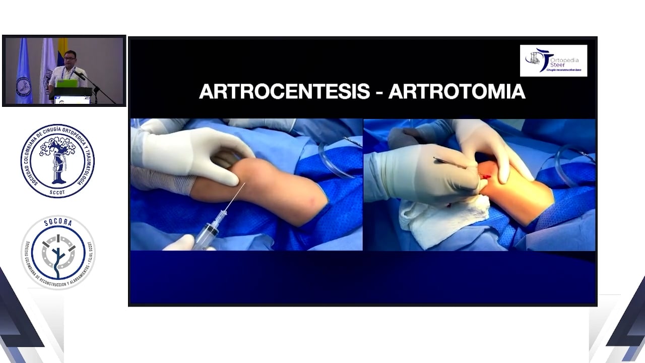 Artritis séptica de rodilla técnica abierta vs artroscópica Cuál es mejor