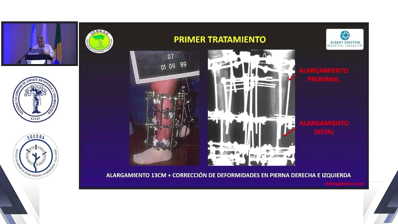 Protocolo de la experiencia de 33 años de alargamiento en pacientes con acondroplasia