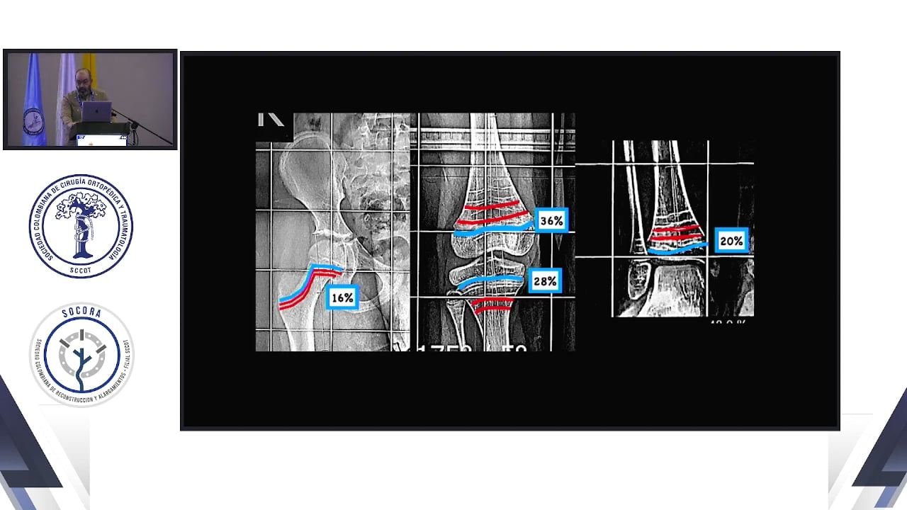 Tratamiento de tibia vara infantil blount