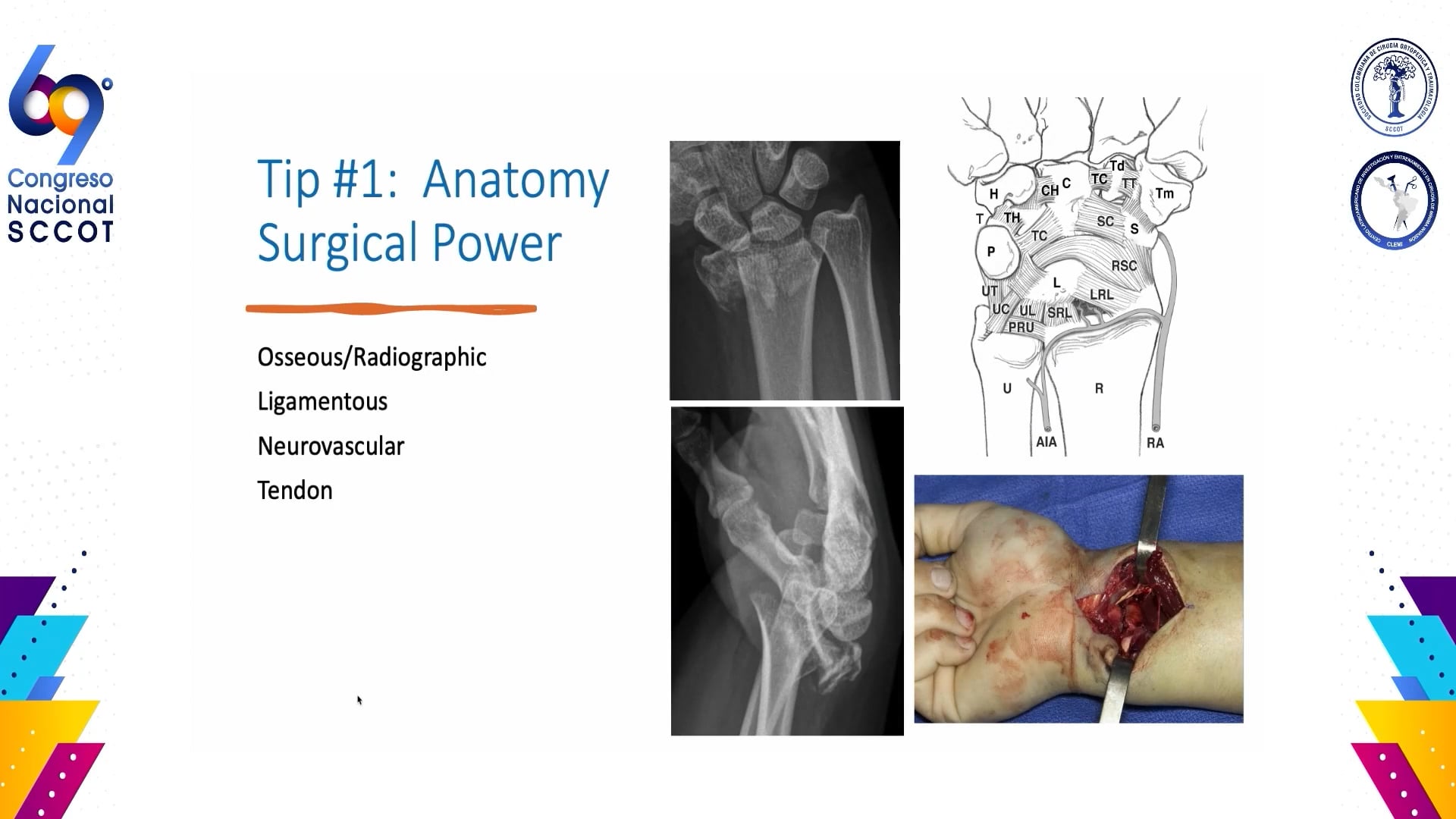 Los 10 mejores consejos para las fracturas del radio distal