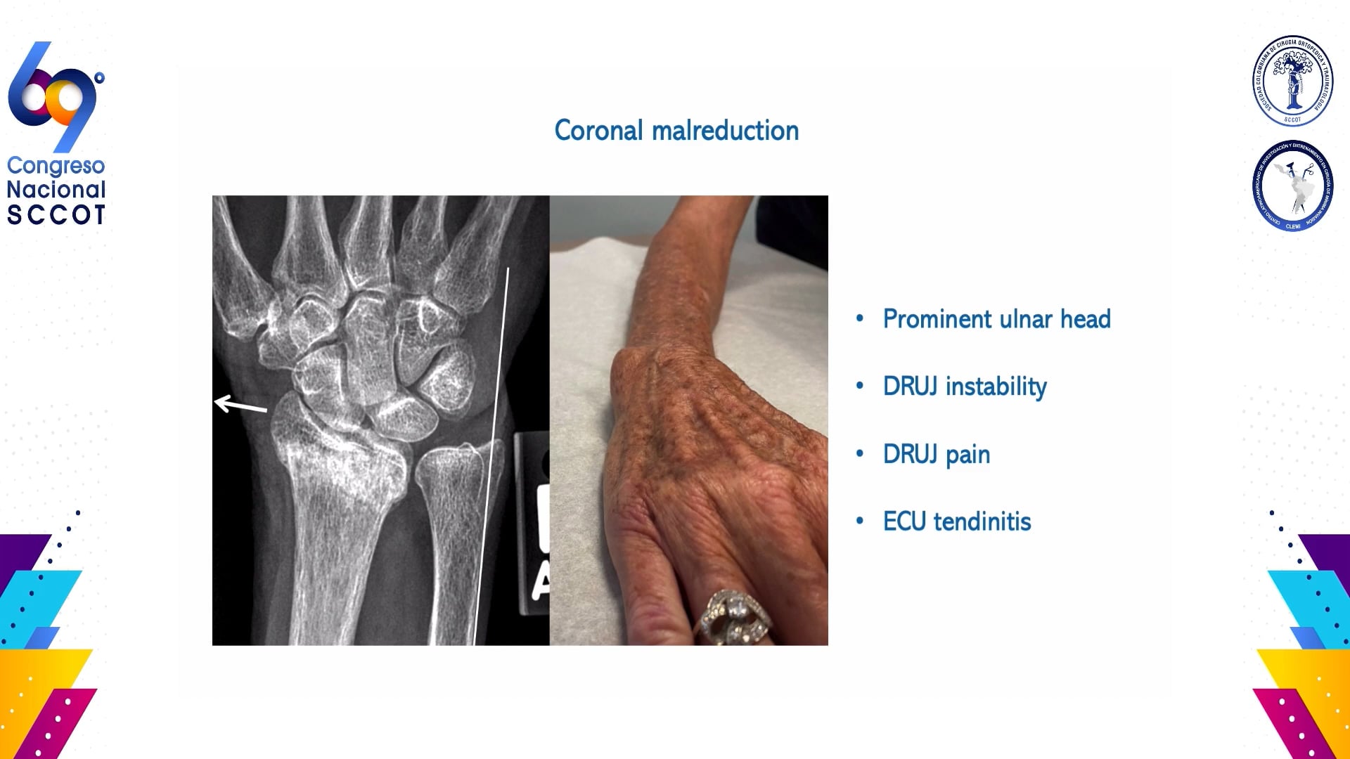 Radiología crítica de fracturas intraarticulares del radio distal.