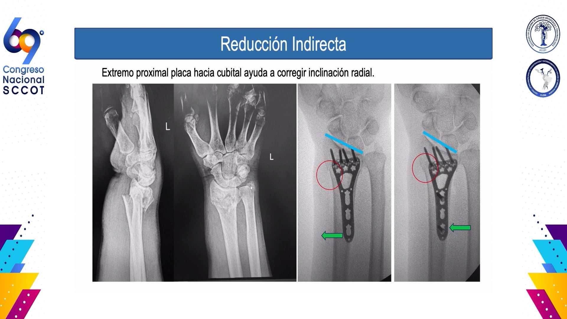 Errores en placas palmares