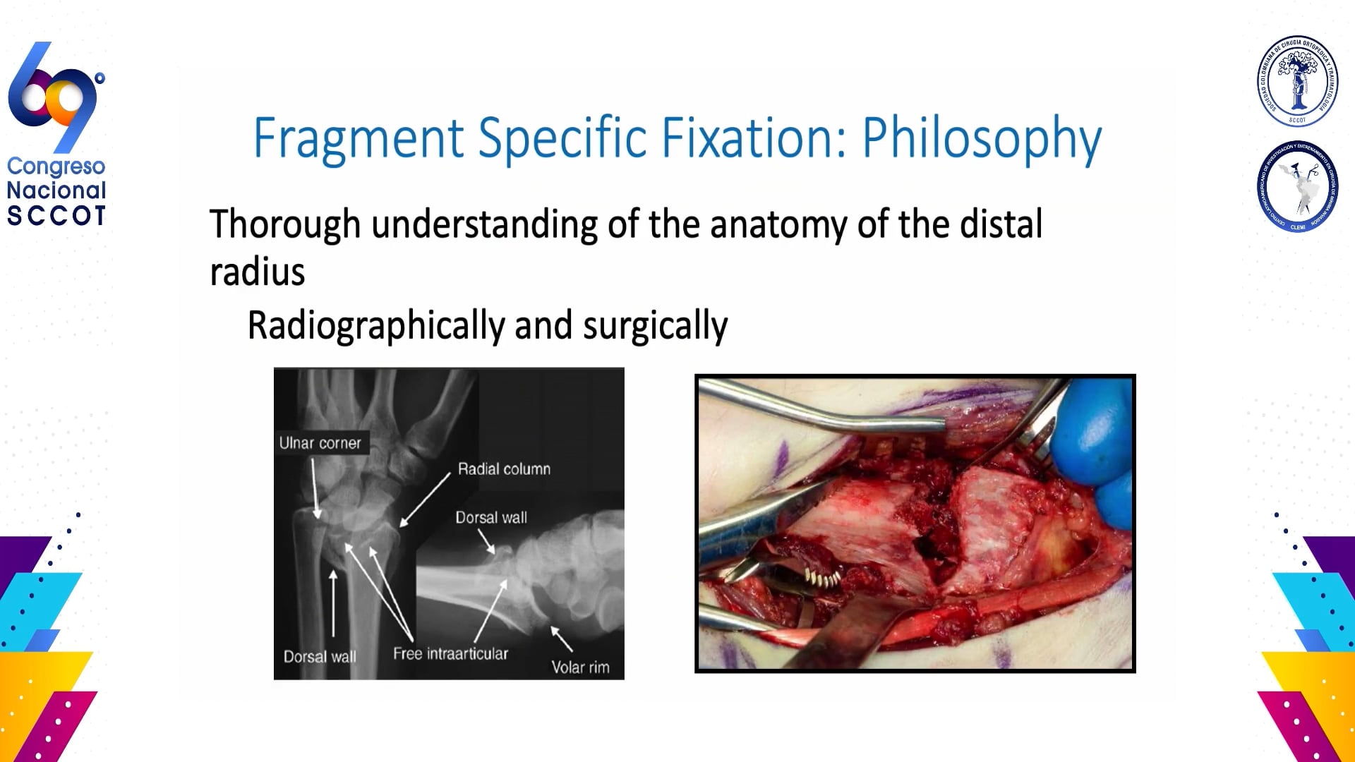 Algoritmo para fracturas intraarticulares complejas del radio distal