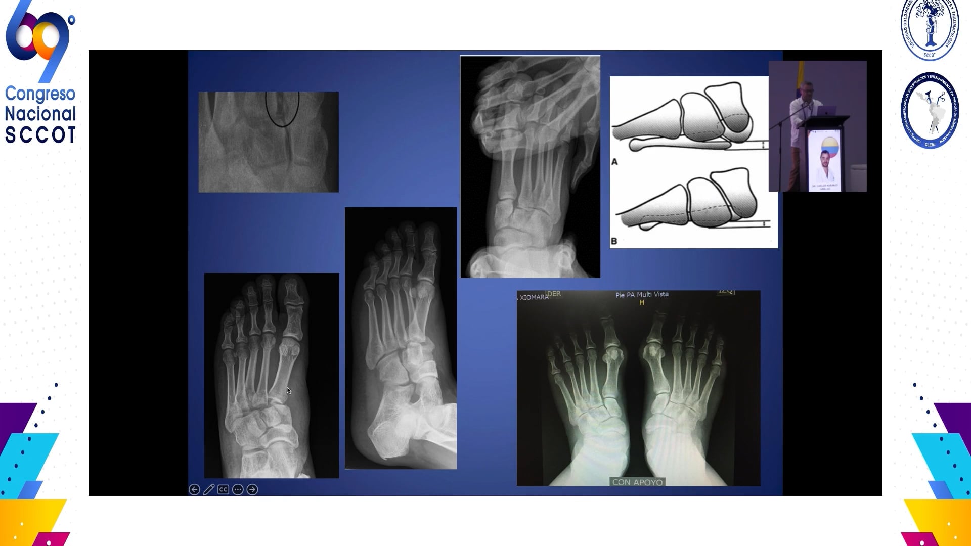 Lesión sutil de Lisfranc