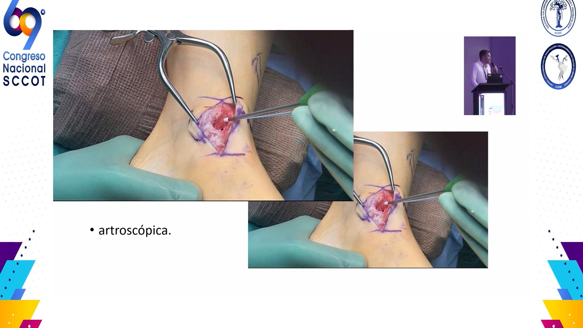 Lesiones de ligamento deltoideo