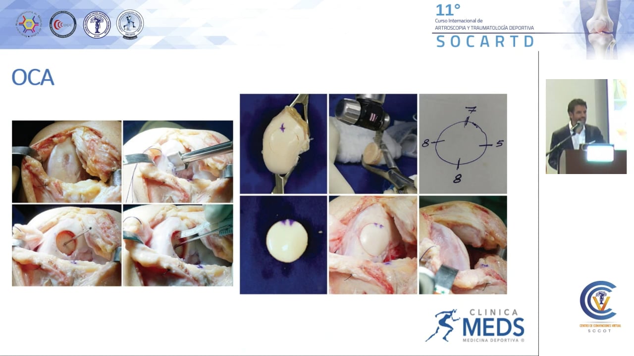 La lesión Osteocondral en el Deportista