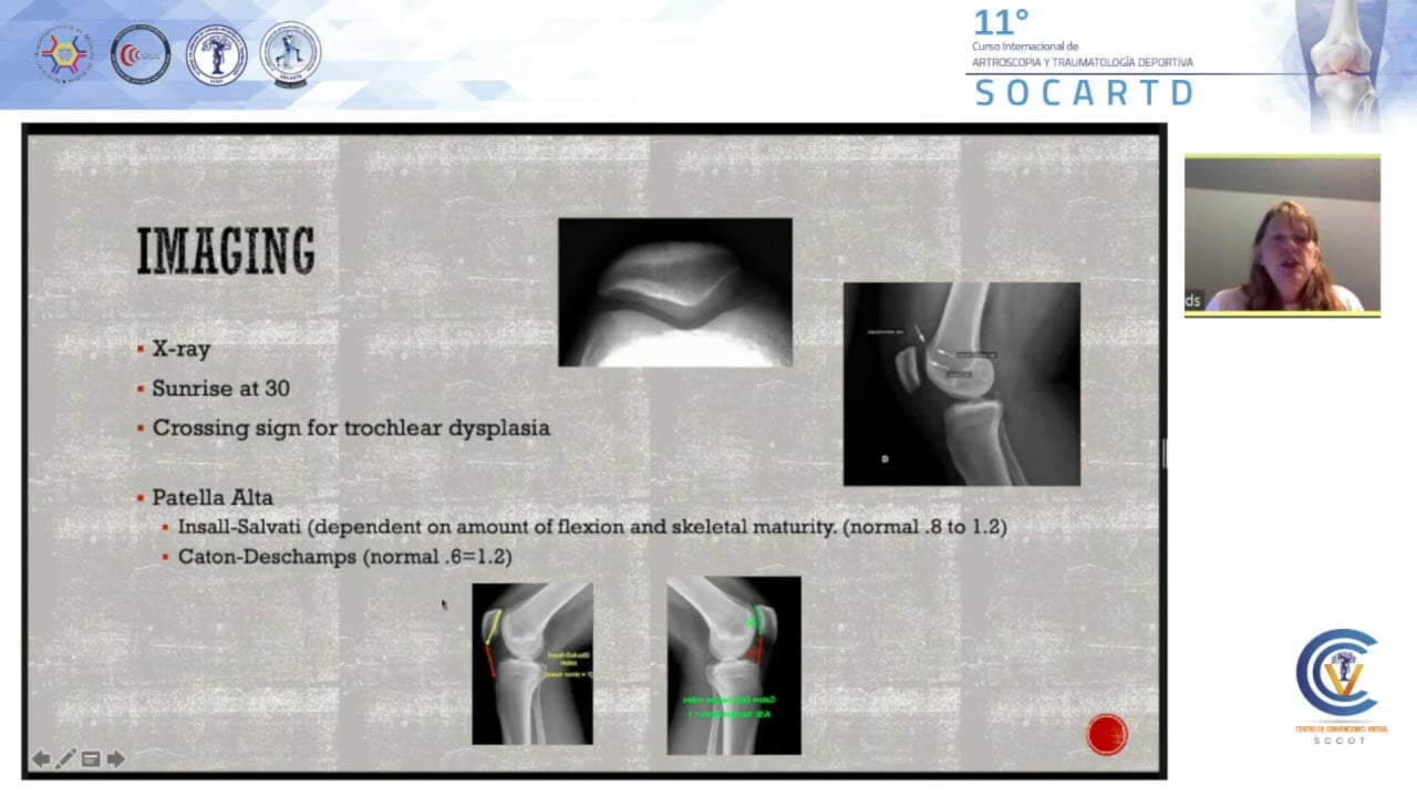 Es suficiente la reconstrucción del Ligamento Patelofemoral Medial