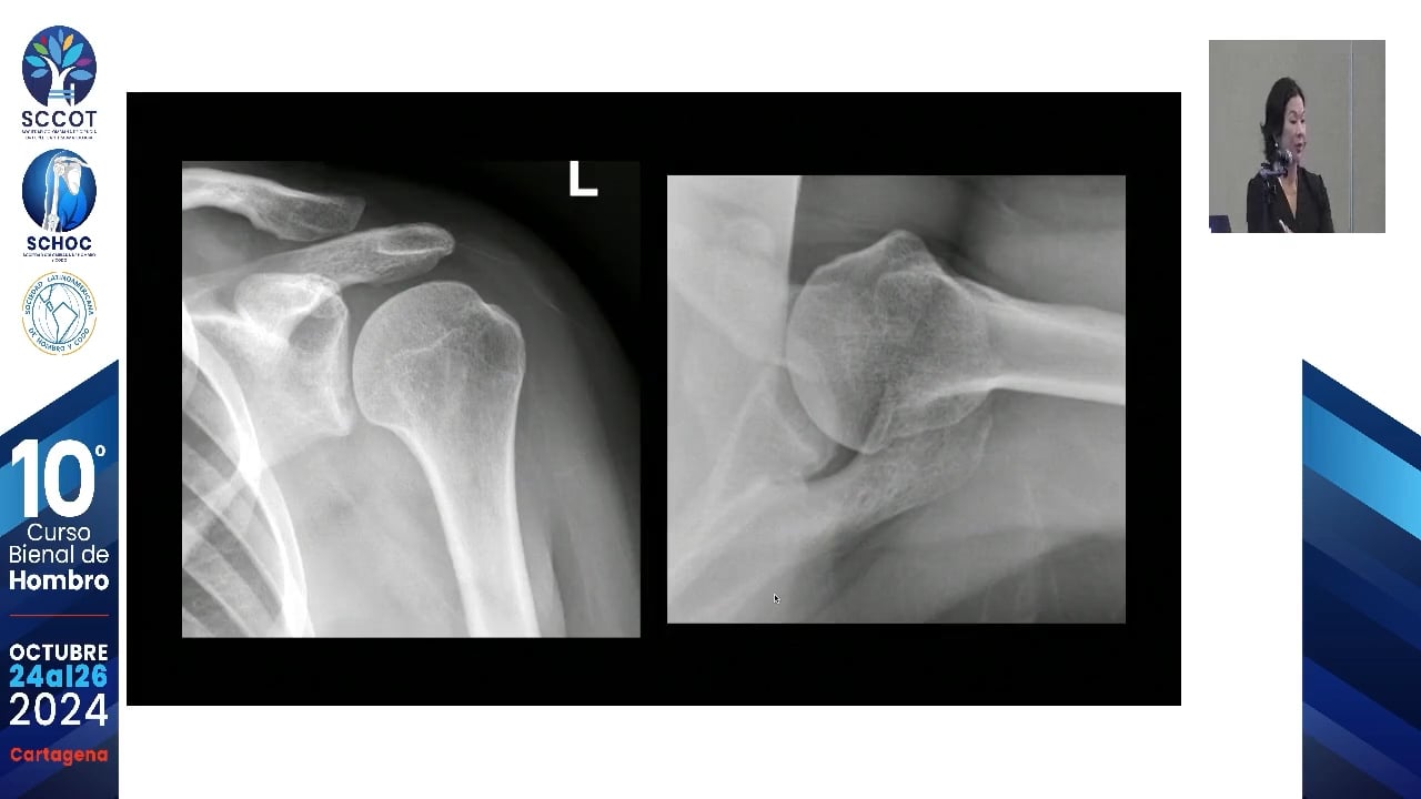 Cuándo la inestabilidad posterior requiere injerto óseo (Toma de decisiones)