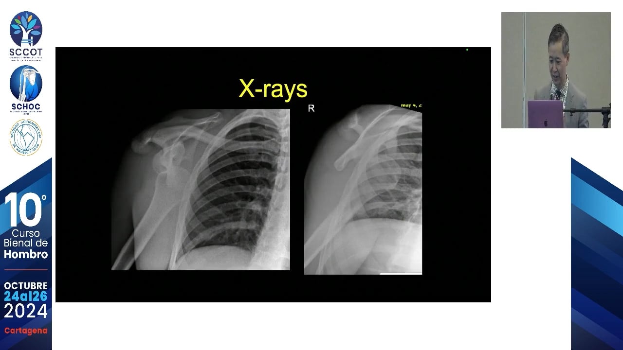 Así procedo en el primer episodio de luxación glenohumeral