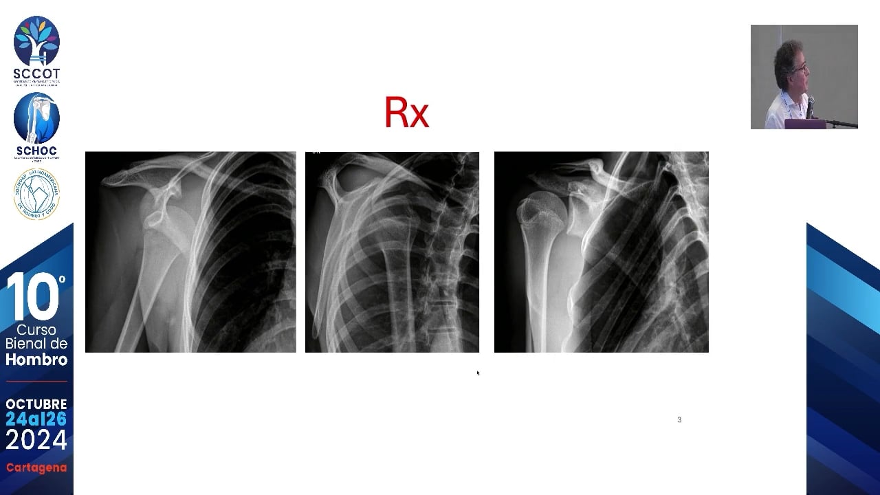 Caso clínico inestabilidad Anterior del Hombro
