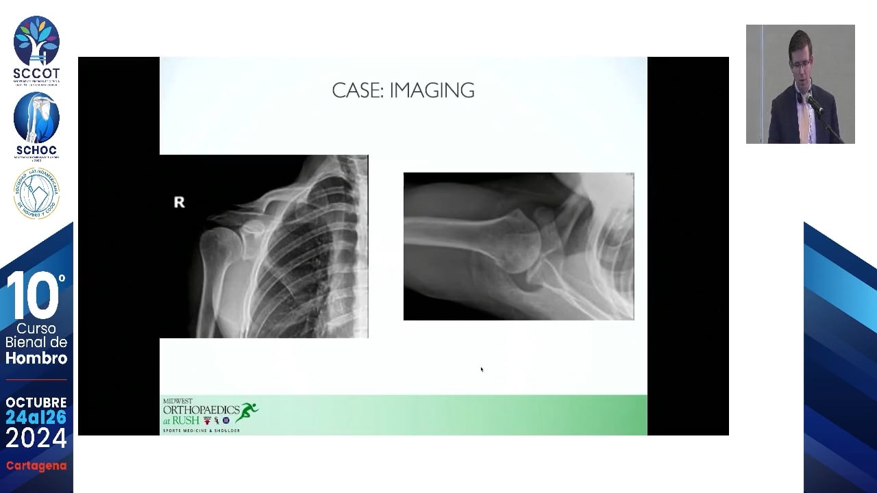 Recurrencia de inestabilidad ¿Qué hacer cuando falla la cirugía de Latarjet?