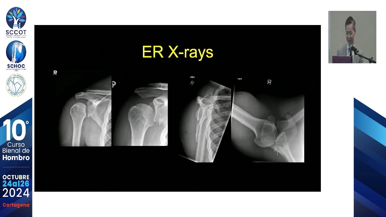 Video - Bloque óseo posterior con tibia distal