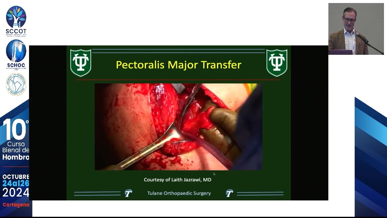 Lesión Subescapular irreparable ¿Qué opciones quedan?