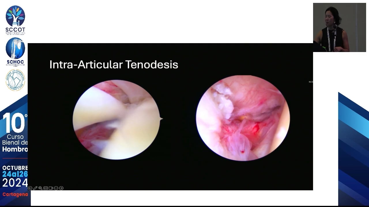 Preferencia en manejo de tendinopatía de bíceps y lesiones SLAP