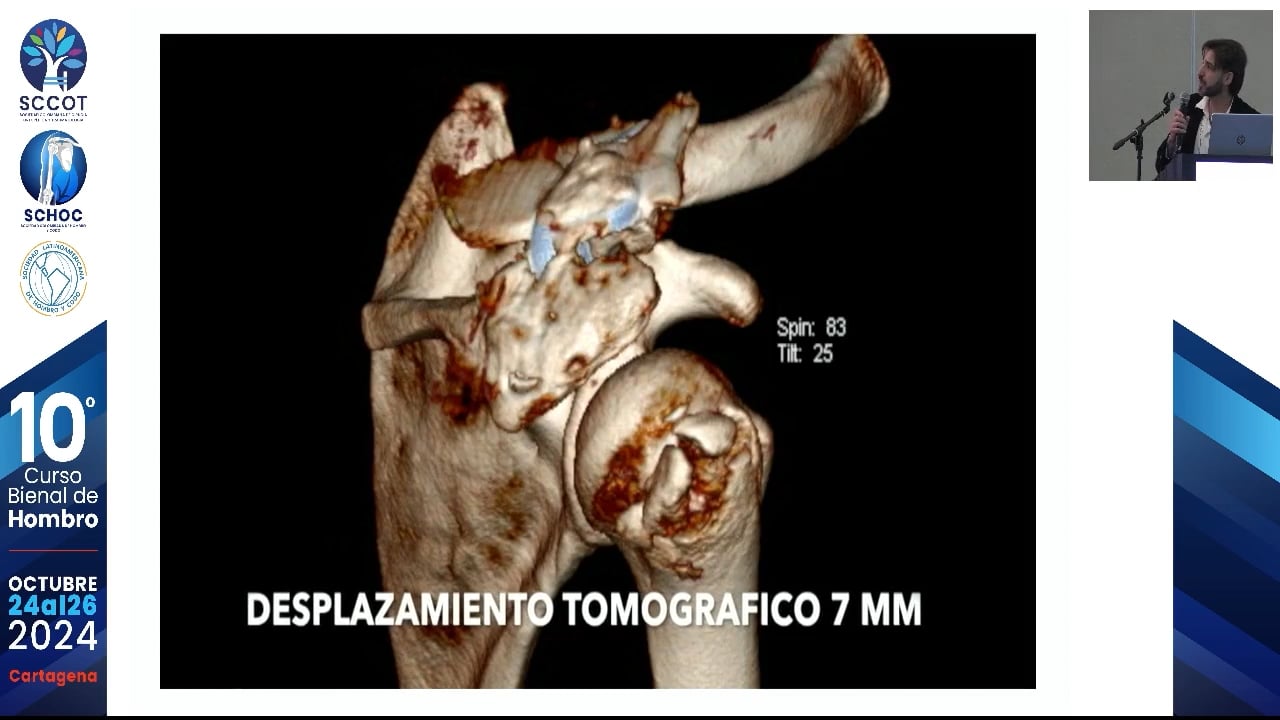Osteosíntesis de tuberosidad mayor asistido por artroscopia