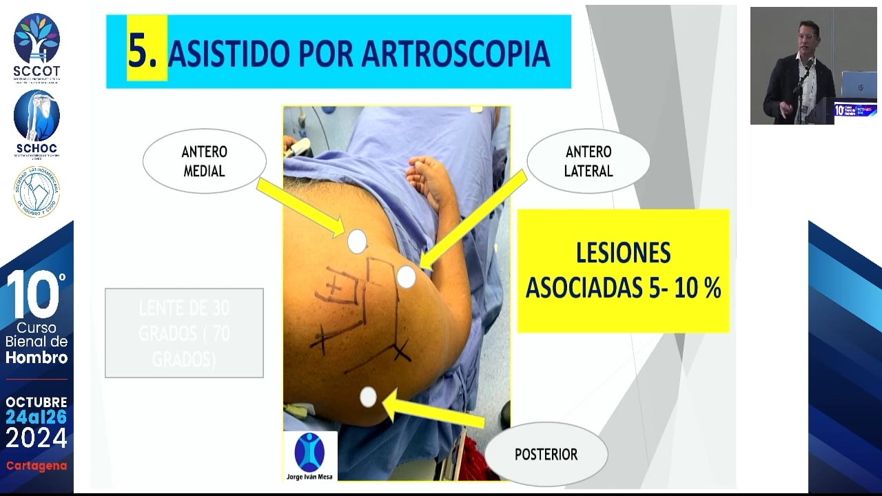 Recomendaciones para un tratamiento Qx exitoso en luxación AC