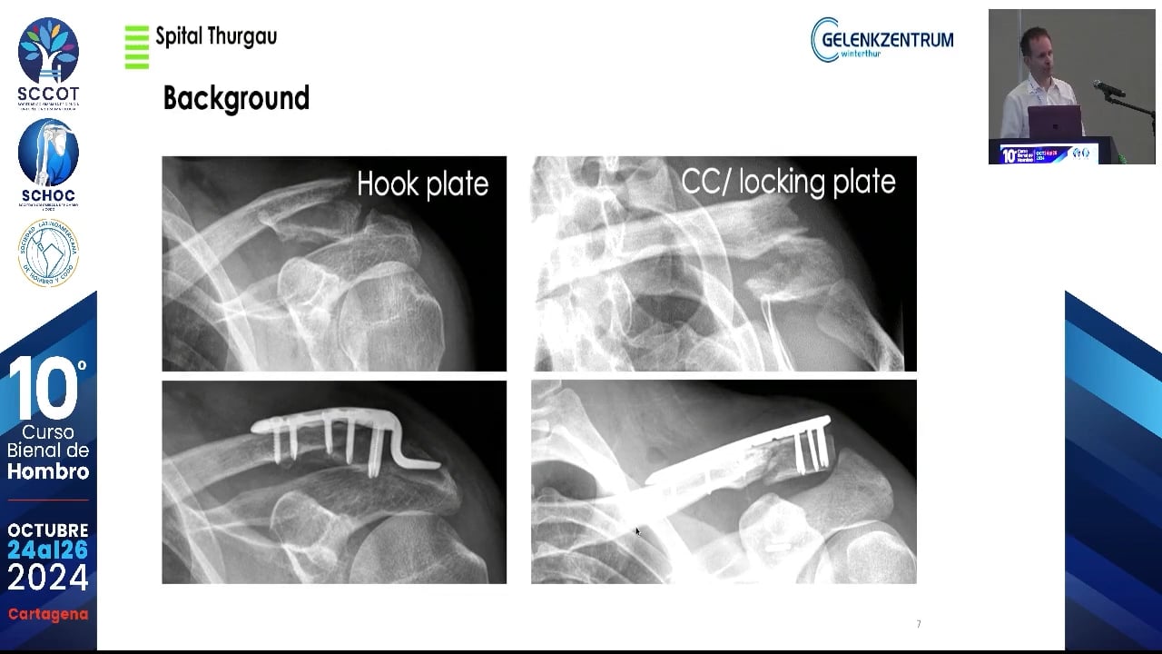 Complicaciones de osteosíntesis de clavícula distal asistida por artroscopia