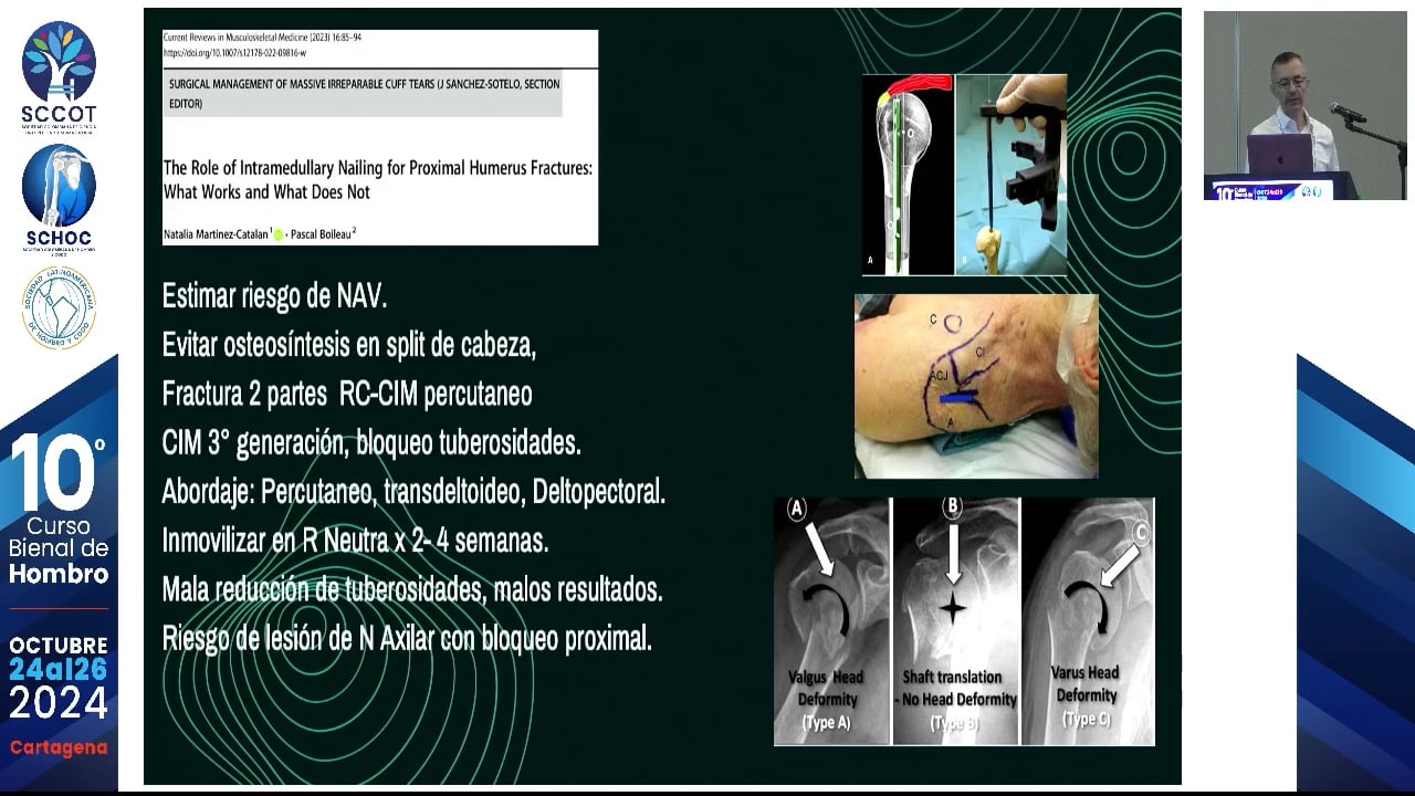 ¿Hay lugar para la osteosíntesis en fx de húmero proximal en paciente anciano?